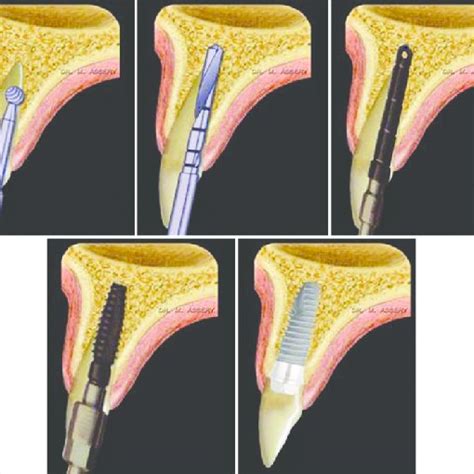 Pdf Immediate Implant In The Esthetic Zone An Evidence Based