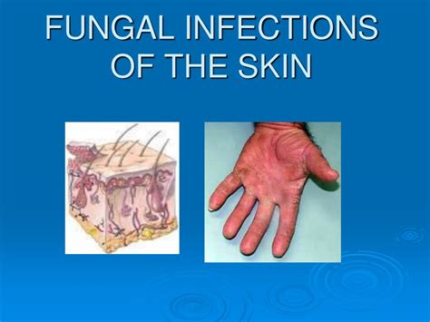 Ppt Integumentary System Pn 124 Bacterial And Fungal Infections