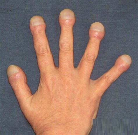 clubbing finger | Medical Pictures Info - Health Definitions Photos