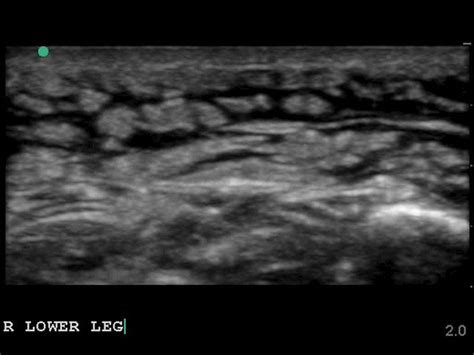 The speed of spread is directly proportional to the thickness of the subcutaneous layer. Temple EM Ultrasound on Twitter: "Cobblestoning-seen in ...