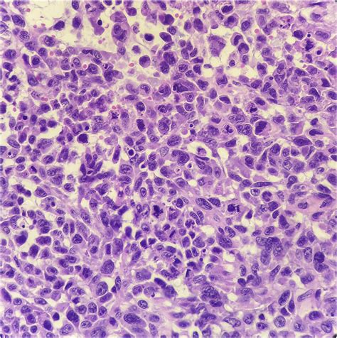 Melanoma Cells Showing Atypia Pleomorphism Evident Nucleoli And
