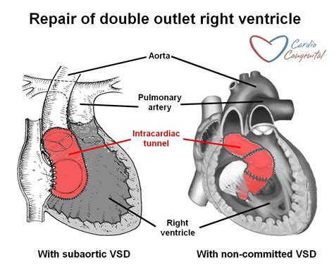 Pin By Nonas Arc On Double Outlet Right Ventricle Medical Careers