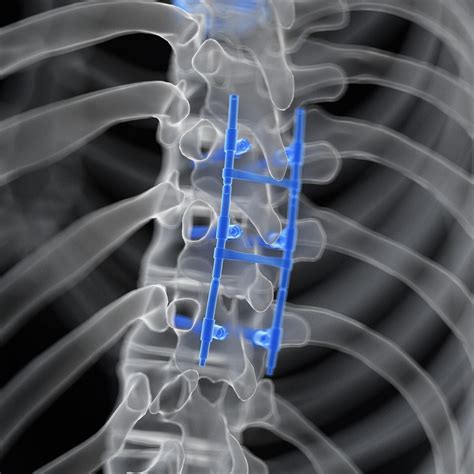Spine Surgery Meaning Types And Risk Factors