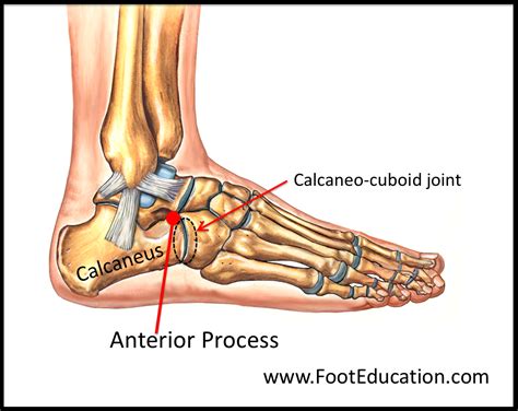 Anterior Process Fracture Of The Calcaneus Footeducation