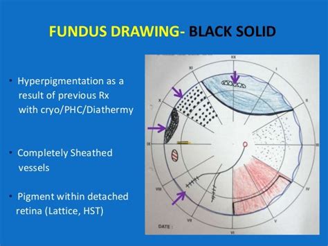 Looking Deep Into Retina Indirect Ophthalmoscopy And Fundus Drawing