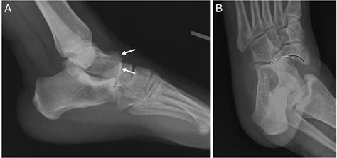 Osseous Injuries Of The Foot An Imaging Review Part 3 The Hindfoot