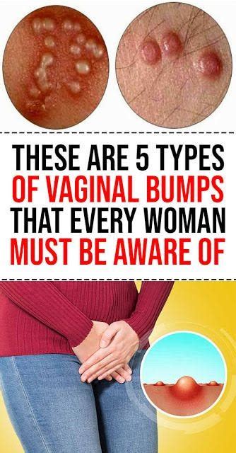 These Are 5 Types Of Vaginal Bumps That Every Woman Must Be Aware Of