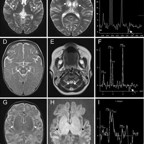Brain Mri Findings In Children With Classical Melas Syndrome A Brain