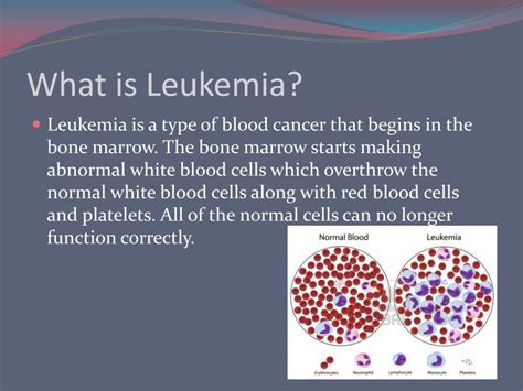 Ppt Leukemia Powerpoint Presentation Free Download Id6499963