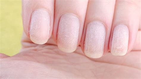 Vitamin B12 Deficiency Signs Of Vitamin Deficiency In Nails Healthshots