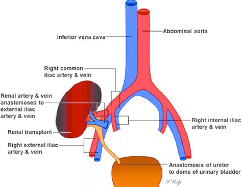 Schematic Of A Renal Transplant Shows The Location Of Vascular And