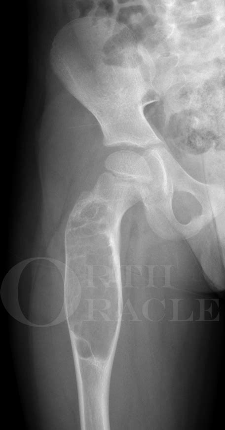 Femur Bone Cyst X Ray