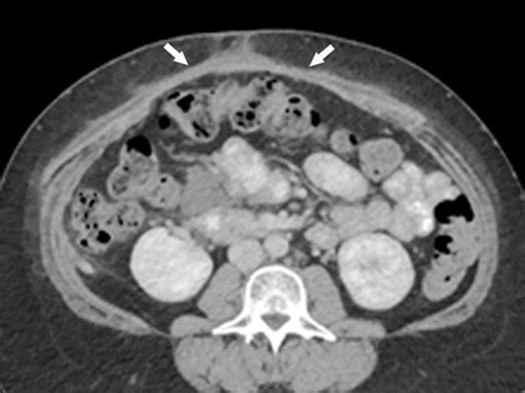 Imaging And Treatment Of Complications Of Abdominal And Pelvic Mesh