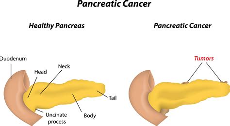 Shape Shifting Pancreas Cells Set Stage For Development Of Deadly Cancer The Stem Cellar