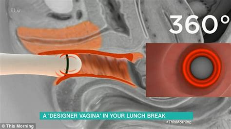 Itv This Morning Shows Designer Vagina Procedure Live Express Digest