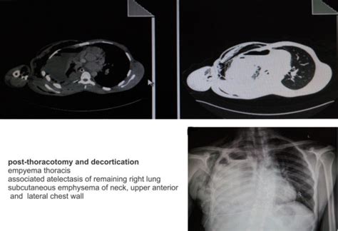 Chest Radiograph And Computed Tomography Ct Scan Illustrating