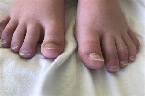 Covid Toe Among Six Unusual Symptoms And Long Side Effects Coventrylive