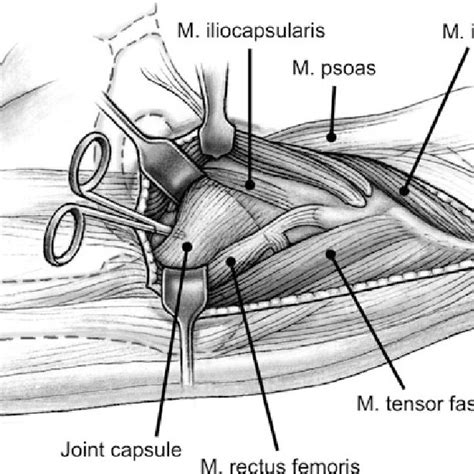The Inguinal Ligament And The Sartorius Muscle Are Detached From Its