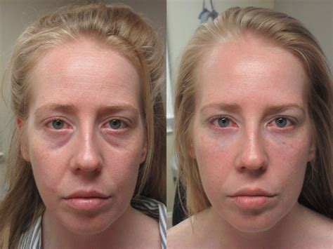 Lower Eyelid Fillers Tear Trough Fillers And Non Surgical