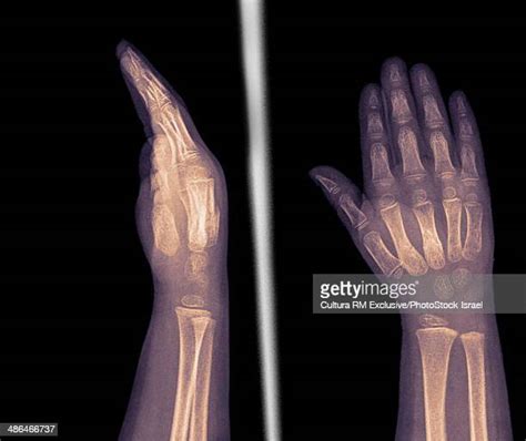 Baby Xray Photos And Premium High Res Pictures Getty Images