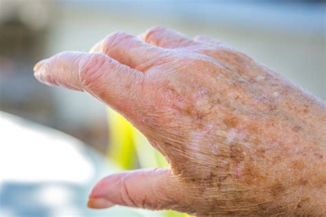 Skin Cancer In The Elderly Can Elder Care Providers Help Home Care Help