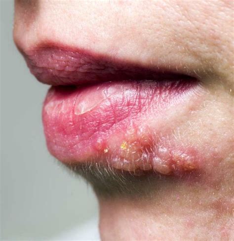 Shingles On The Face Symptoms Treatment And Causes