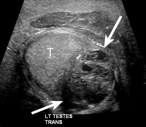 Online Cme Ultrasound Evaluation Of Acute Scrotal Pain