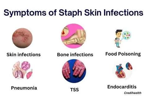 Staph Skin Infections Causes Symptoms Diagnosis And Treatments