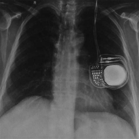 Preoperative Chest X Ray Shows The Implantable Pulse Generator With Its