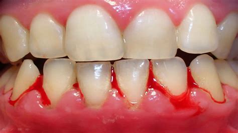 Bleeding Gums Causes Prevention And Learn How To Stop Bleeding Gums