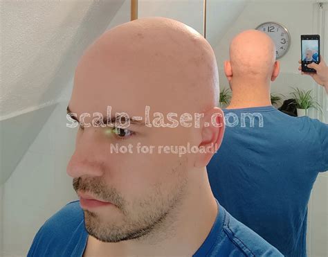 Basic Information About Scalp Laser Hair Removal Kopfhaare Weglasern