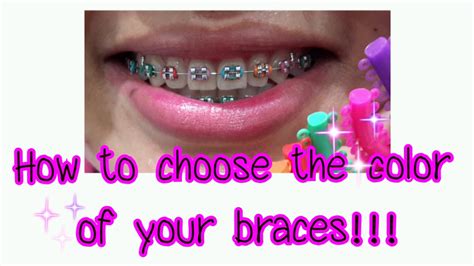 How To Choose The Color Of Your Braces Youtube