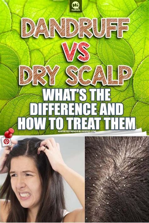 Many People Assume That Dandruff And Dry Scalp Are The Same Condition