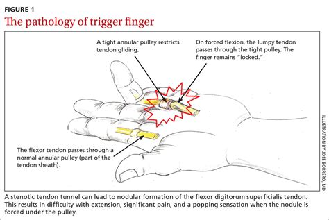 Flexor Tendon Sheath