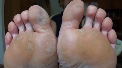 Stinky Soles With Calluse Size 7 Youtube
