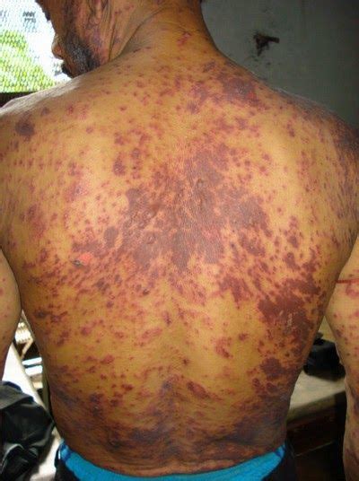 Hiv Severe Symptoms Acute Hiv Skin Rash Side Affects Of Taking Hiv