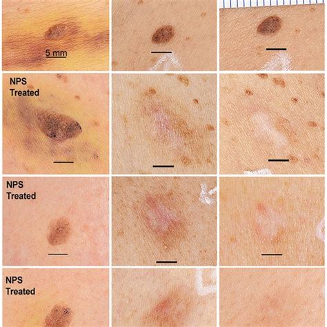 Pigmented Seborrheic Keratoses From A Single Subject Shown Before