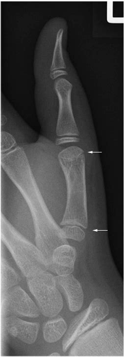 Thumb Fractures Wikiradiography