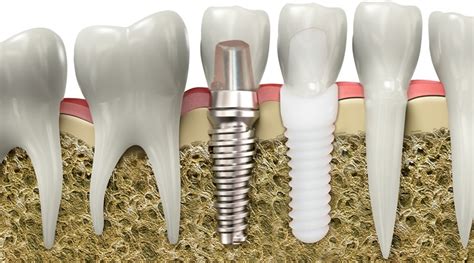 Implantes Dentales De Zirconio Cerámica Solución Dental