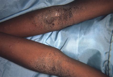 Eczema On Black Skin What To Know Arabia Day