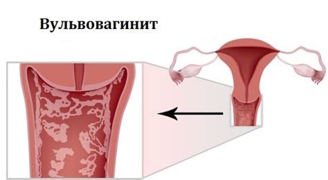 Vulvovaginitis Tratamiento S Ntomas Causas Tipos