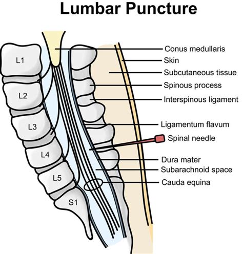 Lumbar Puncture Procedure Position And Lumbar Puncture Side Effects