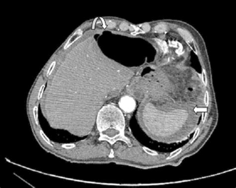 Axial View Of Abdomen Ct Scan With Contrast Showing Perforation Of The