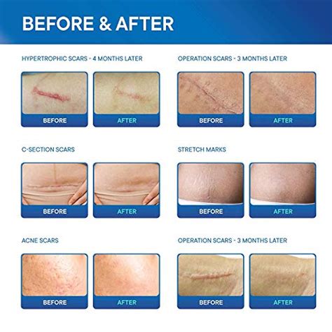 Best Silicone Scar Sheets For Getting Rid Of Scars Reviewed 2020