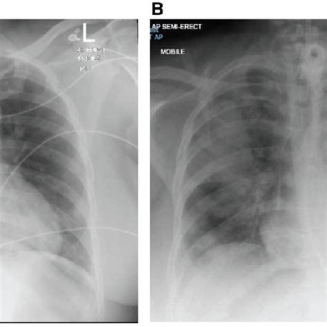 Case 2 Radiographs A Post Intubation Plain Chest Radiograph On Day