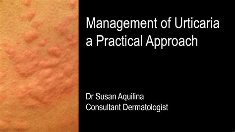 Management Of Urticaria A Practical Approach Youtube