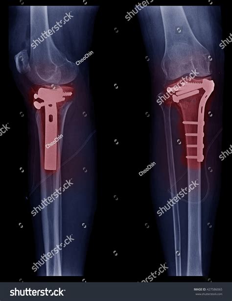 Xray Image Bone Fracture Tibia Fibular Stock Photo 427586065 Shutterstock