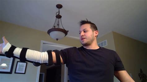 Distal Bicep Tendon Rupture Surgery Update Youtube