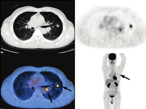 Petct Scan Shows One Pulmonary Nodule At The Left Upper Lobe With