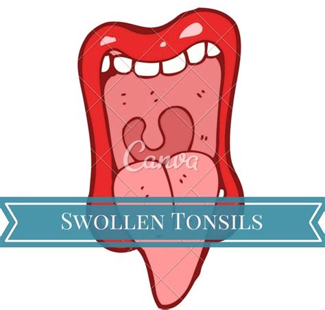 Swollen Tonsils Causes Picture Symptoms And Treatment